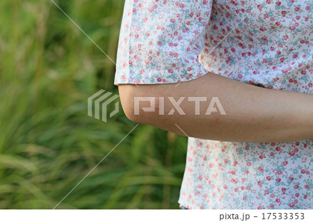 蚊に刺された後の湿疹 17533353