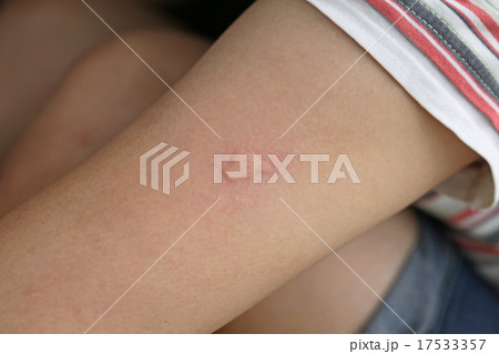 蚊に刺された後の湿疹 17533357