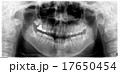 歯医者　レントゲン 17650454