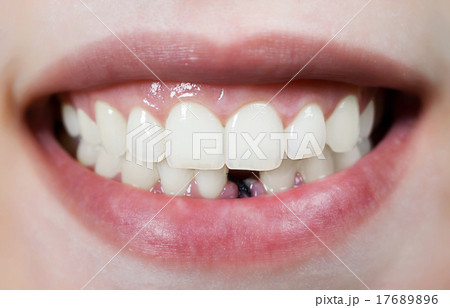 Smile without front tooth 17689896