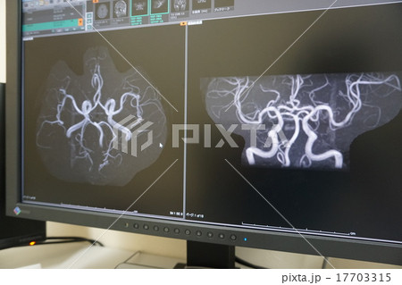 脳血管MR 17703315