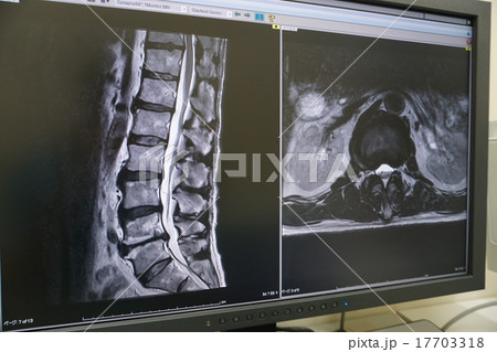 腰椎MRI 17703318