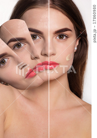 Young girl with acne skin 17860980