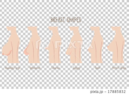 Breast Shape Chart -comparing Large, Unbalanced,Tuberous,sagging