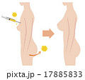 豊胸 Breast Fatgrant Surgery with sideview of body 17885833