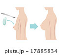 豊胸 Silicone Breast Implant with sideview of body 17885834
