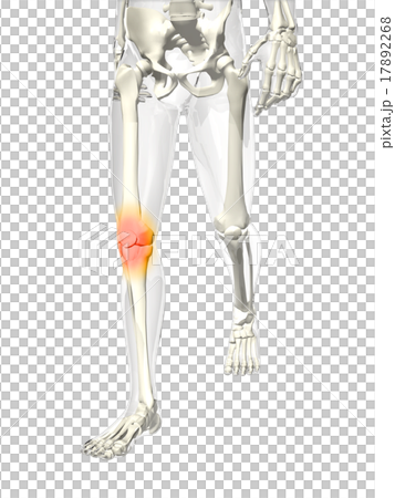 膝關節疼痛 17892268