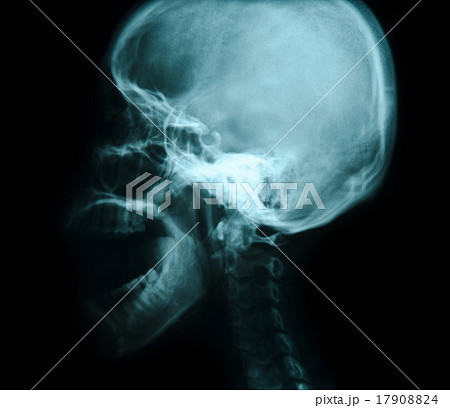 X-ray picture of the skull X-ray picture of the skull 17908824