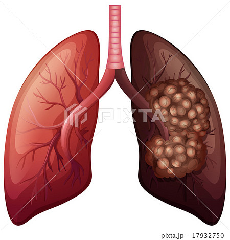 Normal Lung And Lung Cancerのイラスト素材