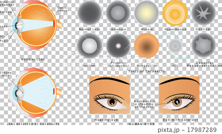 Cataract 17987289