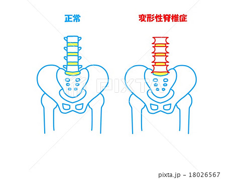 変形性脊椎症のイラスト素材