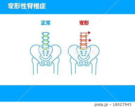 変形性脊椎症のイラスト素材