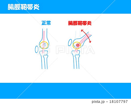 腸脛靭帯炎 18107797