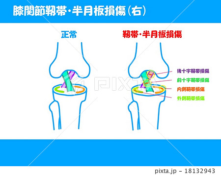膝関節靭帯 半月板損傷のイラスト素材