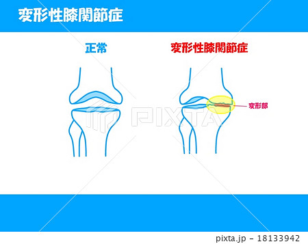 変形性膝関節症のイラスト素材