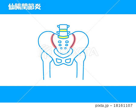 仙腸関節炎 仙腸関節炎 18161107