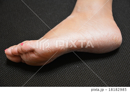 乾燥肌 乾燥肌 18182985