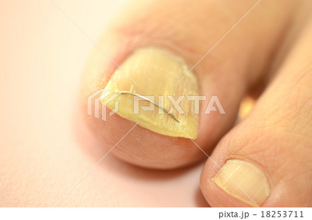足の親指の巻き爪の治療 18253711