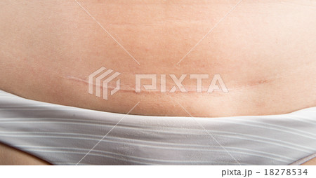 close up Caesarean c/s operation give birth on woman tummy 18278534