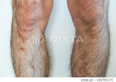 成長痛のオスグッド病 18290135