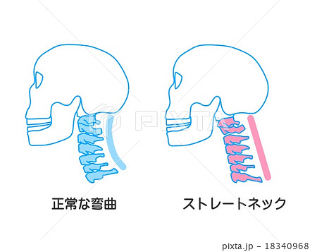 「ストレートネック フリー素材」の画像検索結果