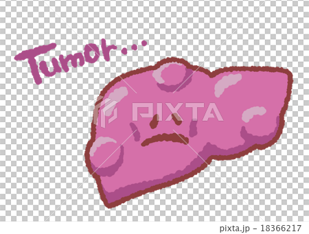Tumor formed with liver character 18366217