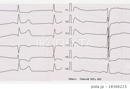 ECG with acute period of myocardial infarct 18366223
