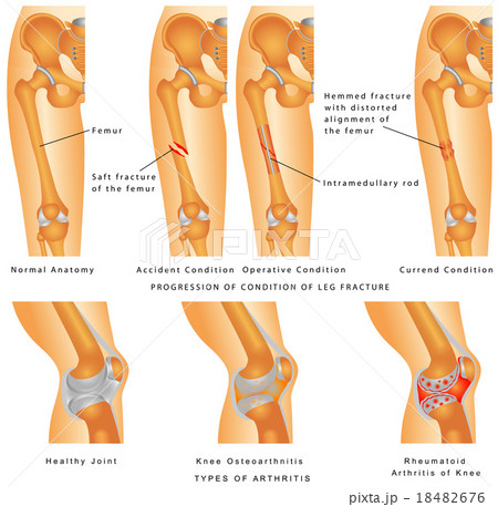 Fractures of Femur 18482676