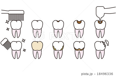 歯のトラブル　きれいな歯と虫歯 18496336