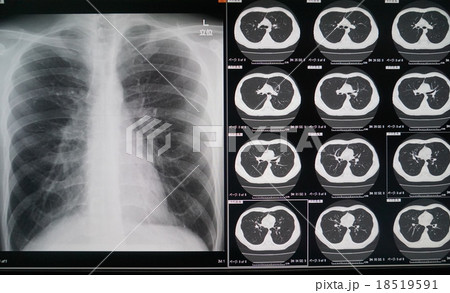 胸部Xp、CT 18519591