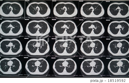 肺CT 18519592