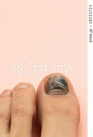 内出血した爪 左足親指の写真素材