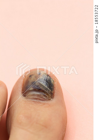 内出血した爪 左足親指 内出血した爪 左足親指 18553722