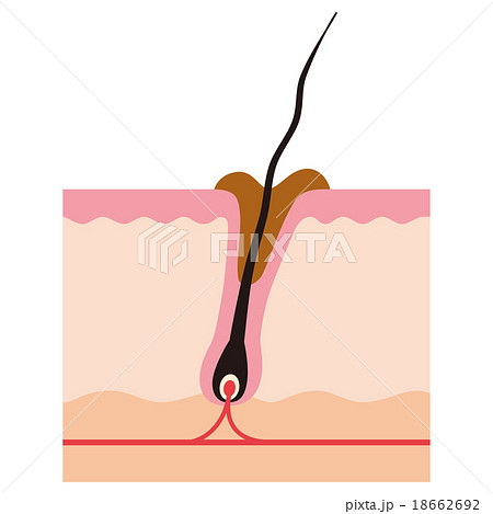 毛　毛根の断面図　汚れた毛穴 18662692