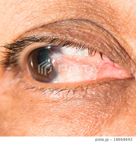 pterygium 18668692