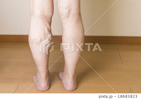 下肢静脈瘤 下肢静脈瘤 18683823