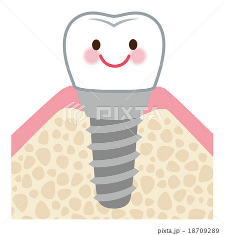 歯 インプラント キャラクターのイラスト素材 18709289 Pixta