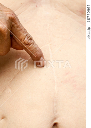 the old man's stomach and a scar from the surgery. 18770965