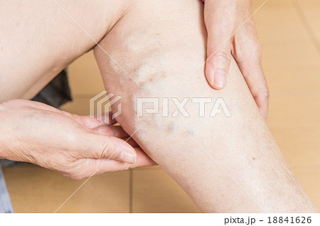 下肢静脈瘤 18841626