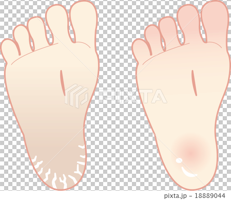 之後的鞋跟護理 18889044