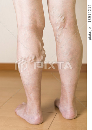 下肢静脈瘤 18914214