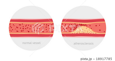 Atherosclerosis in vessels 18917785