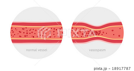 Healthy and sick human vessels 18917787