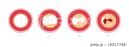 Atherotrombosis in vessels 18917788