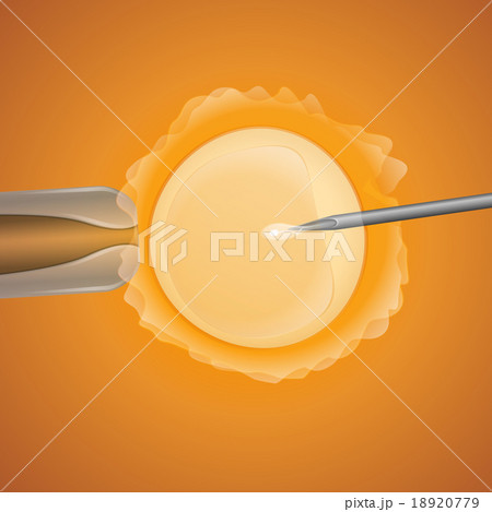 in vitro fertilization in vitro fertilization 18920779