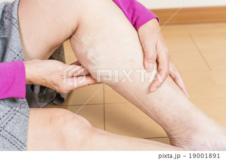 下肢静脈瘤 19001891