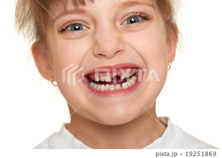 lost tooth girl face closeup 19251869