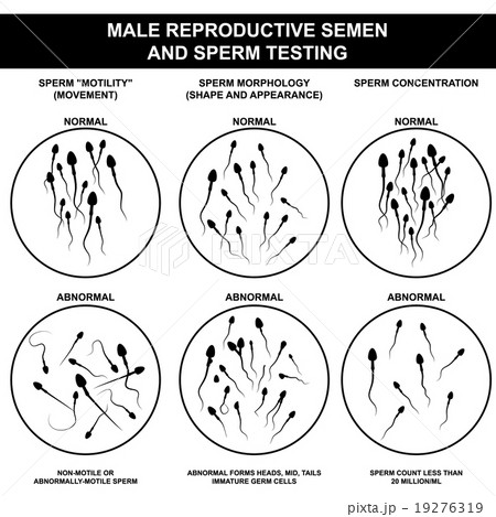 normal and abnormal sperm 19276319