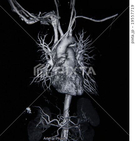 Ct scan angiogram (take photo from film x-ray) Ct scan angiogram (take photo from film x-ray) 19557719