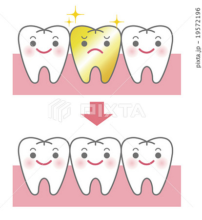 金歯とセラミックの比較イメージのイラスト素材